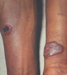 Skin lesions on a human