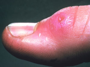 Thumb swollen pink ulcer